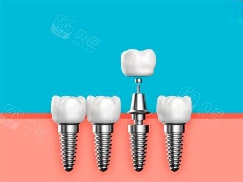 牙齿搭桥的三种主要方法：单颗种植、固定桥梁与可摘桥梁