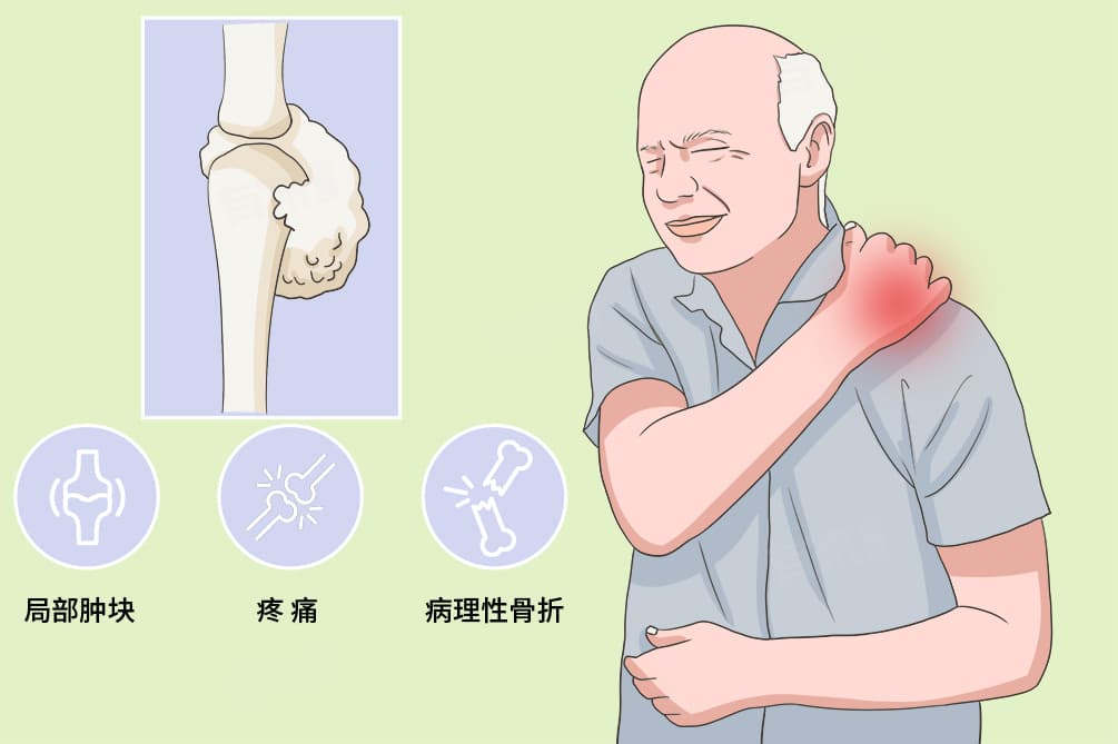 骨转移症状全解析：从疼痛到高钙血症