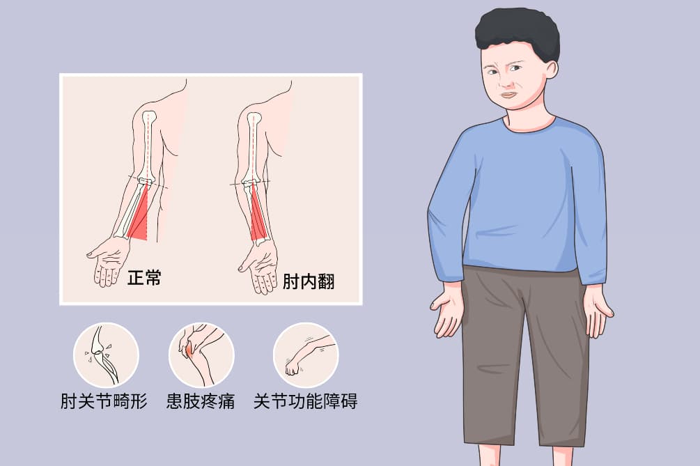 肘内翻畸形：病因、症状、诊断与治疗全解析