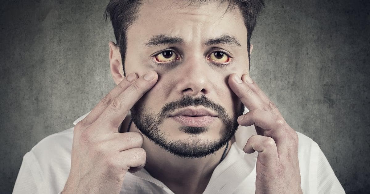 黄疸，眼黄，比想象中的危险更大