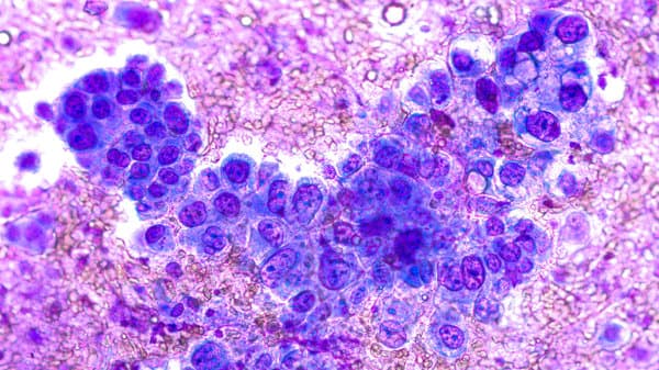 急性髓细胞白血病骨髓象M3：特征、诊断与治疗