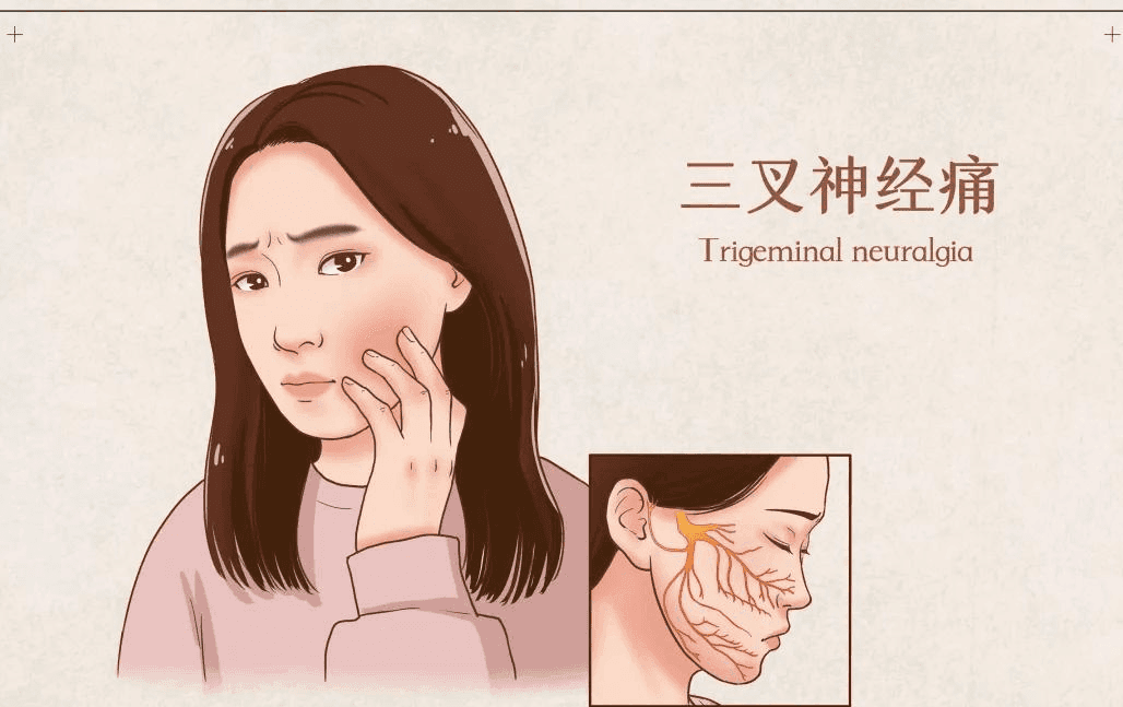 显微血管减压术治疗面肌痉挛--让“面抽”消失