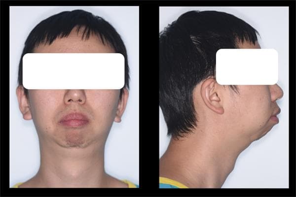 四川大学华西口腔医院正畸-正颌-关节外科联合诊疗，拯救患者“消失”的下巴