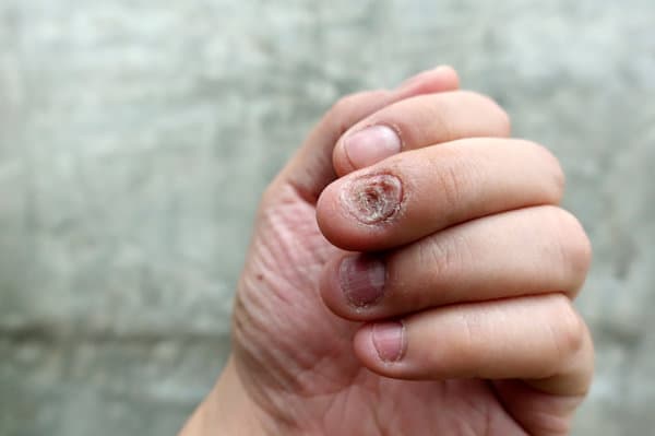 儿童指甲营养不良怎么治疗