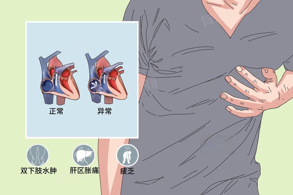 心脏二三尖瓣反流的原因及治疗方法