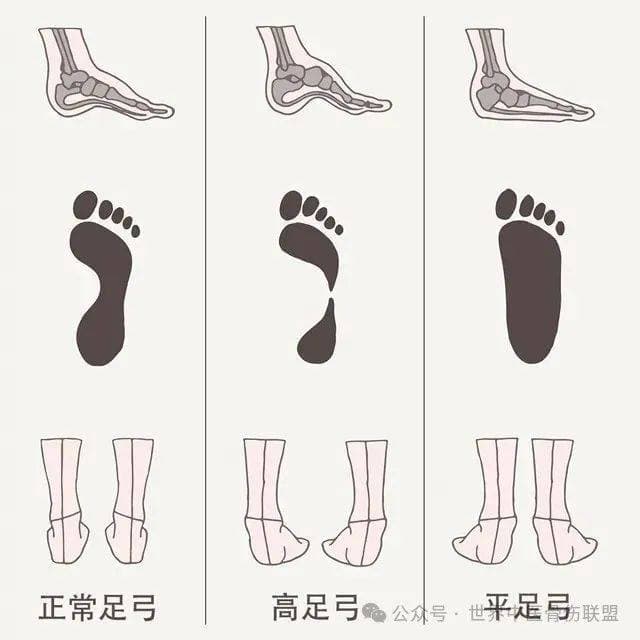 扁平足进行跑步运动，会有危害吗？