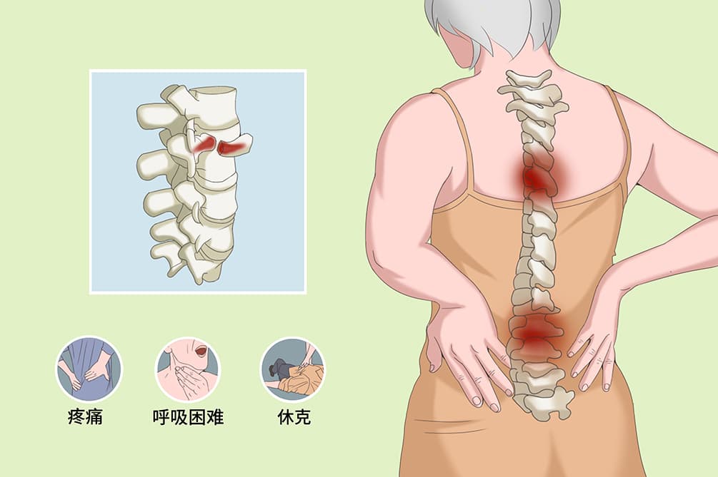 从2月到1年：腰椎骨折恢复时间的影响因素