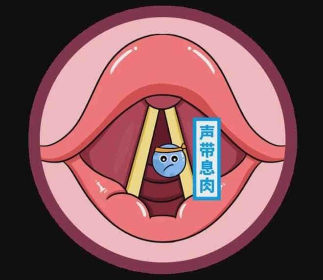 声带息肉七问七答：长了声带息肉，一定要手术吗？