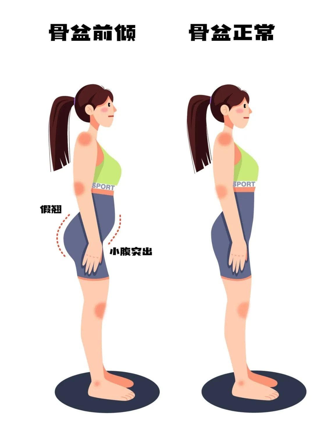 警惕这种“S”型身材！不是胖！4招帮你矫正