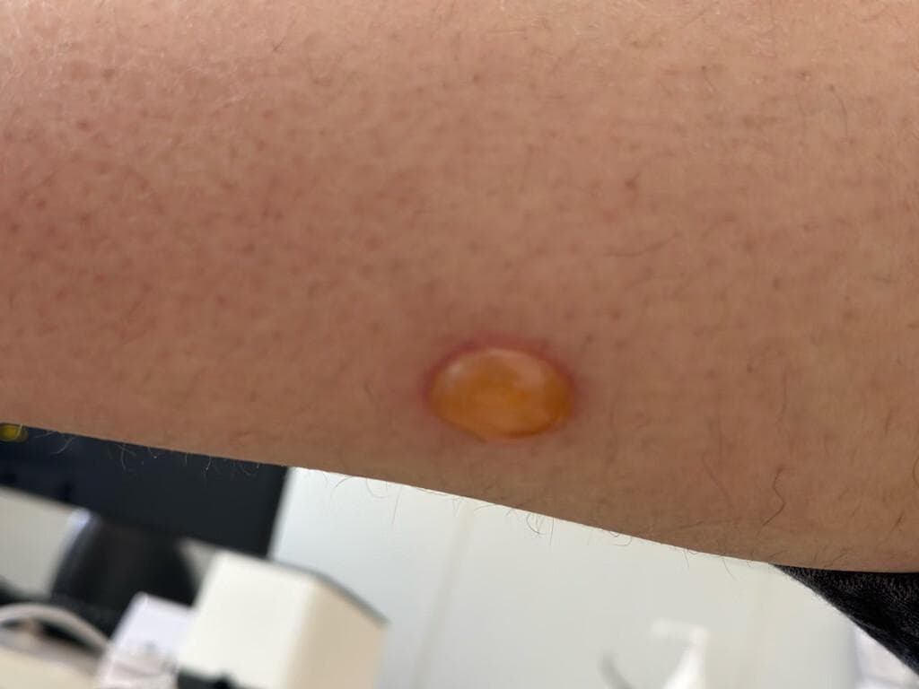 低温烫伤的居家换药指南