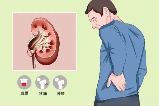 国际罕见病日 | 血尿不痛≠没事！警惕泌尿系统“隐匿杀手”