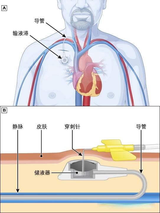 一文详解输液港六大并发症：从预防到治疗