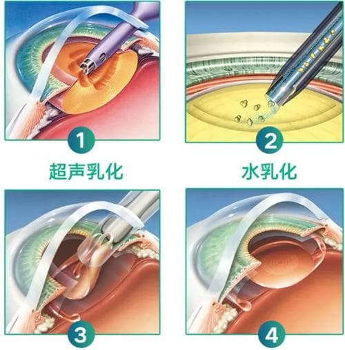 超声乳化白内障手术步骤是什么?价格多少?吸除后需要植入晶体吗?