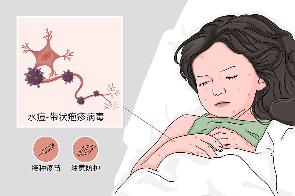 水痘的传播途径