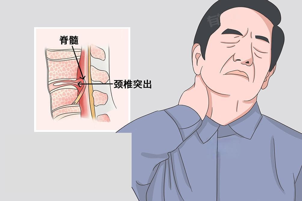 脊髓型颈椎病怎么治疗比较好