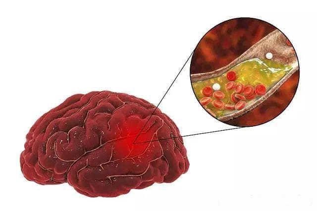 首个评估细胞治疗急性缺血性中风的试验结果出炉