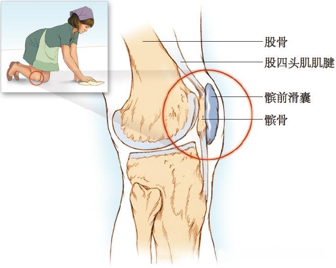 剖析膝关节不同位置滑囊炎：解剖、病因、症状和检查