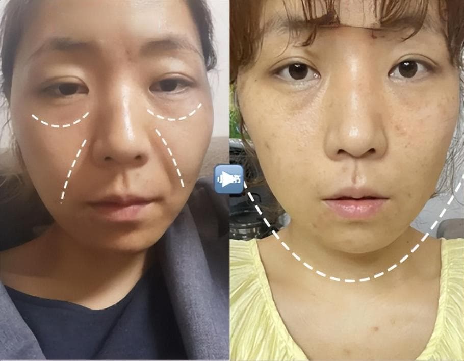 脸凹、脸垮自救！5个动作让五官变耐看，网友：堪称徒手“整容”