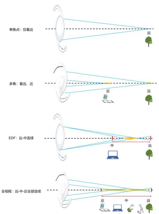 同时视觉人工晶状体为国民视觉健康提供更优选择