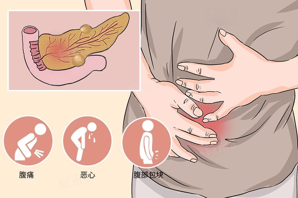 胰腺囊肿的症状表现及临床特征