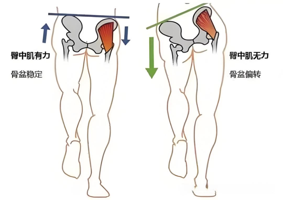 臀中肌：腰-腿-膝联动疼痛的关键治疗点