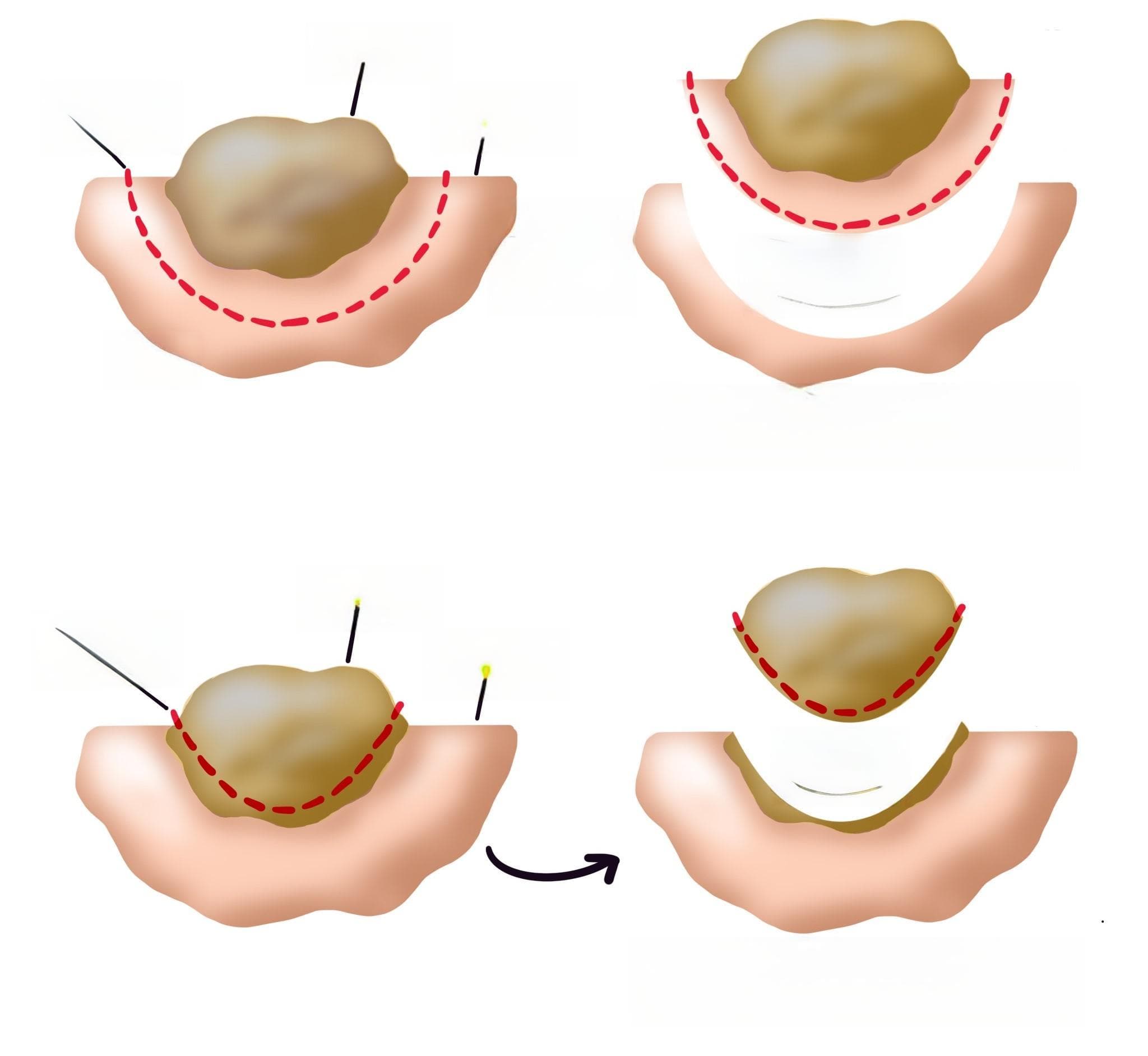 胃肠道间质瘤 (GIST)：症状、病因、诊断与治疗