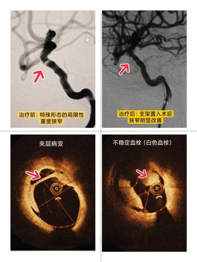 湖北省第三人民医院率先开展OCT指导脑血管介入手术