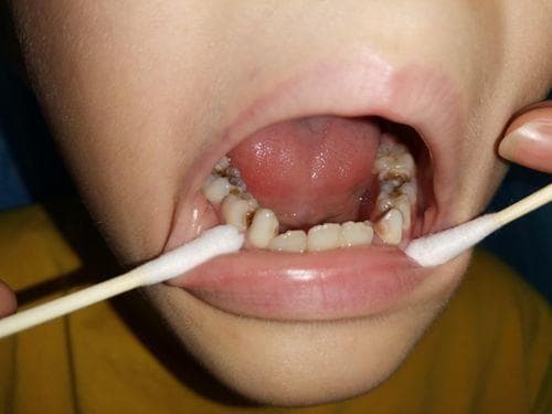 孩子乳牙龋坏要怎么处理？儿童补牙时要注意什么？