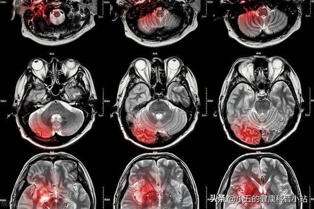 安宫牛黄丸是治疗脑卒中、病毒性肺炎的中成药，科学服用注意4点