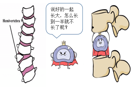 关爱青少年脊柱健康系列之二： 半椎体畸形