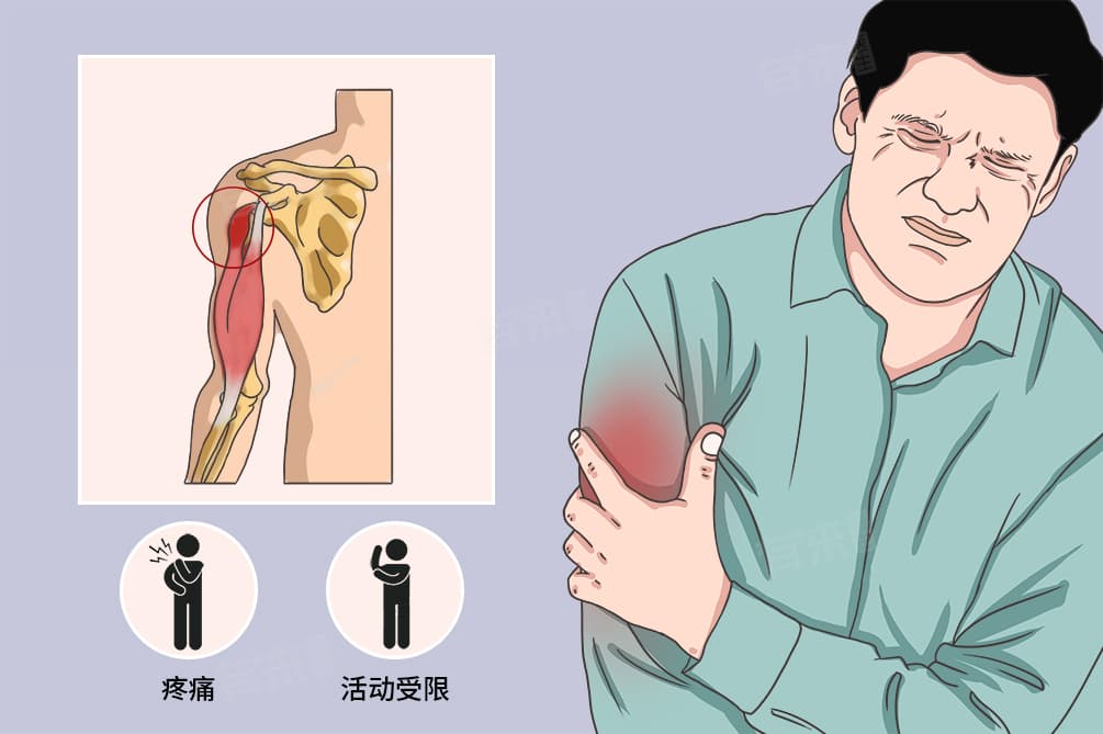 肱二头肌长头肌腱炎症状及应对方法