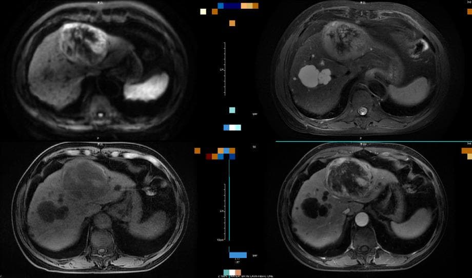 为什么肝癌很少用PET-CT？