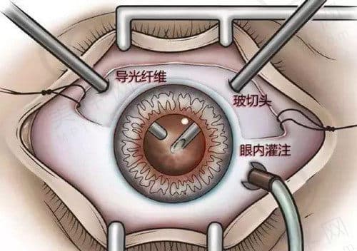 玻切手术后眼睛为什么看东西模糊？术后注意事项全解析