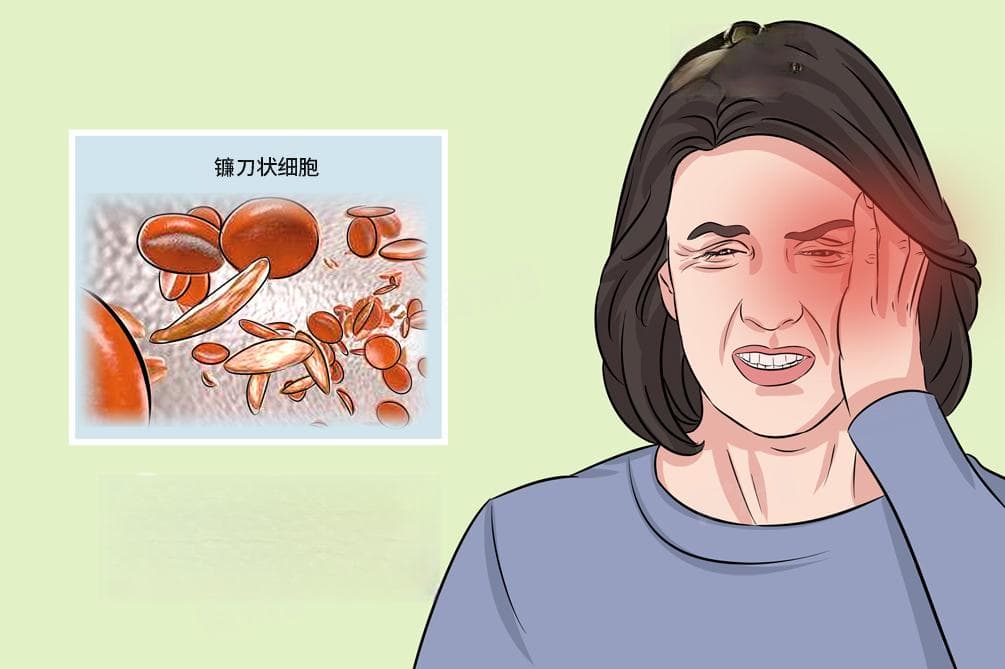镰状细胞贫血是什么遗传病