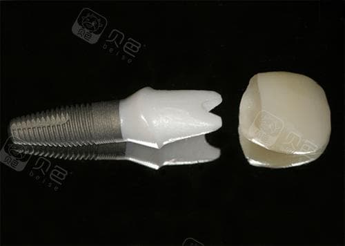 种牙选择一体冠还是分体冠好?分析两种种植牙冠的优缺点!瞬间明白选哪个适合