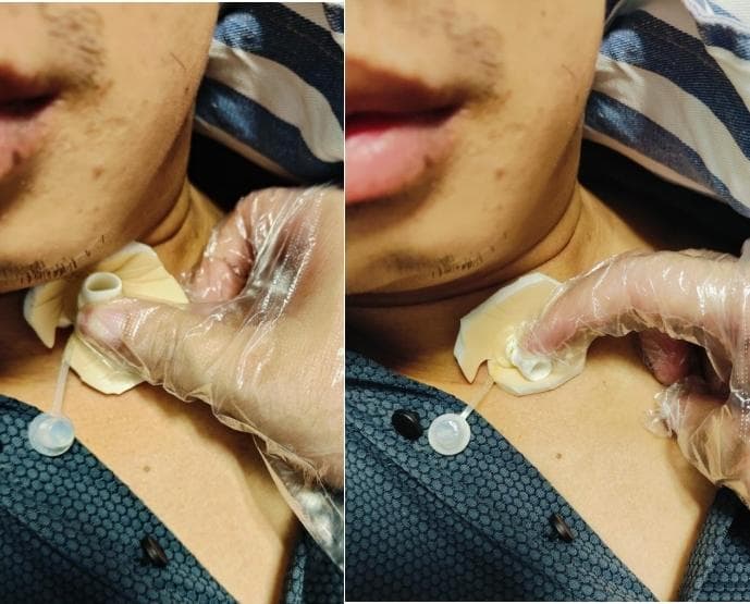 气道狭窄患者安全T管置入后，术后康复有这些注意事项！