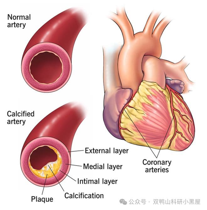 一文了解冠脉血管内超声（IVUS）的原理与应用