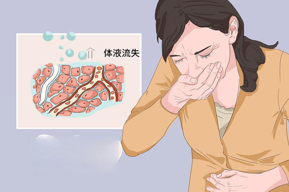 低渗性脱水