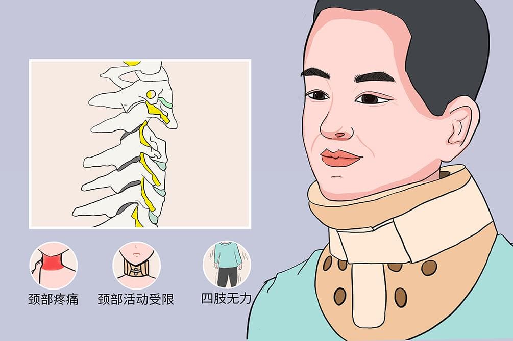 颈椎射频消融手术详解：原理、步骤与风险