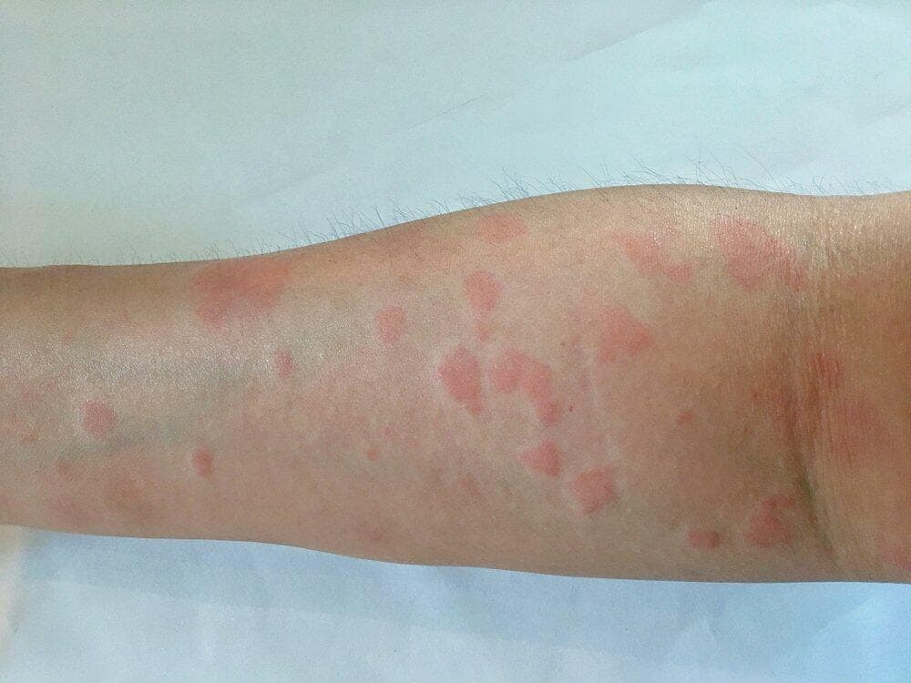 红斑性狼疮会好吗？初期症状、寿命、原因及饮食禁忌一次看