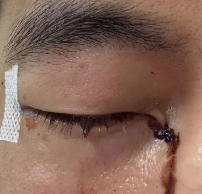 陶勇医生谈郭艾伦眼部伤情，这几点提醒每个人都该看看