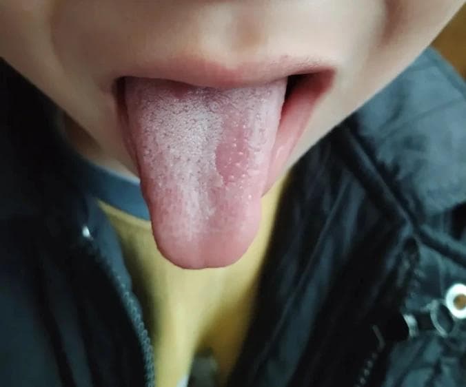 你为什么会得地图舌？患有地图舌该怎么做？