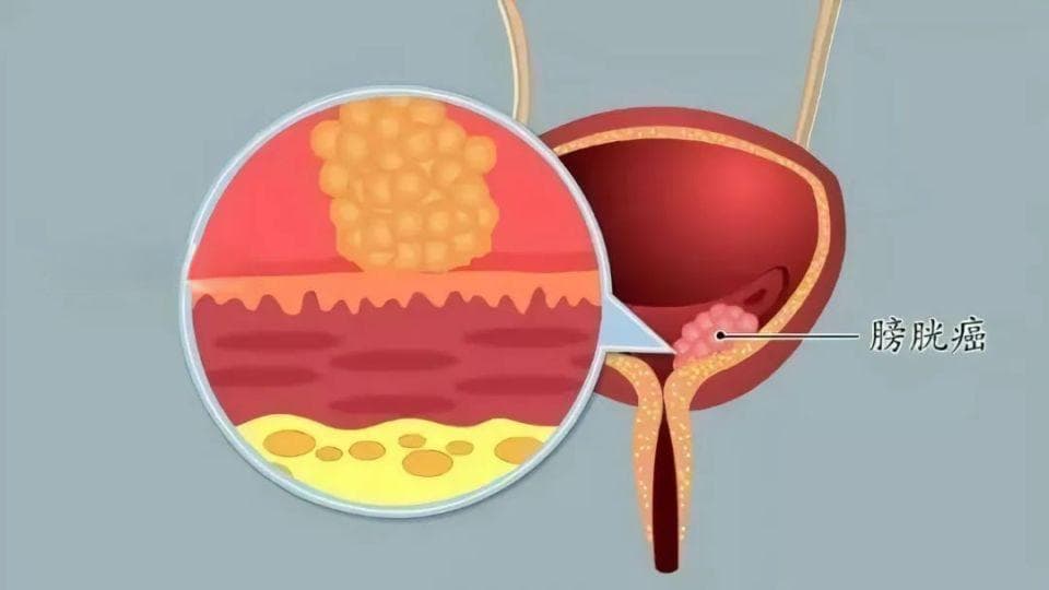 膀胱癌的筛、诊、治、分子检测全流程