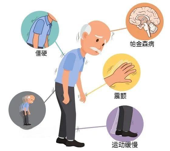 章泽天自曝"帕金森基因"，手抖就是帕金森病吗？