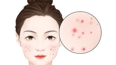 红蓝光治疗痤疮效果如何