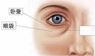 一术双效：新型手术破解眼袋泪沟治疗难题