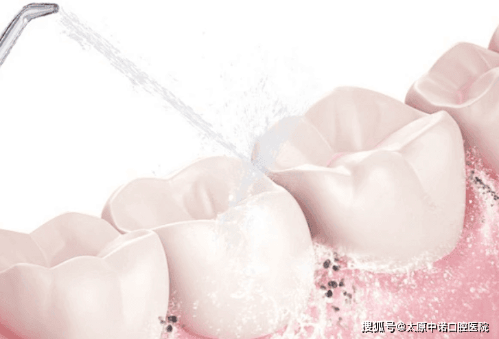 洁牙的目的是什么呢？是不是洁牙以后就能消除口臭呢？