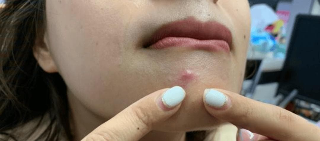 告别"痘痘脸"！从痘痘位置看健康信号，你的身体在说什么？