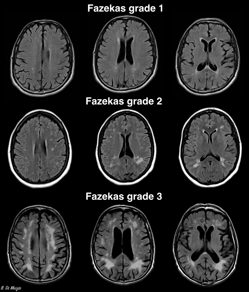 神经内科医生解读：头部核磁报告中的Fazekas 1级是什么意思？需要干预吗？