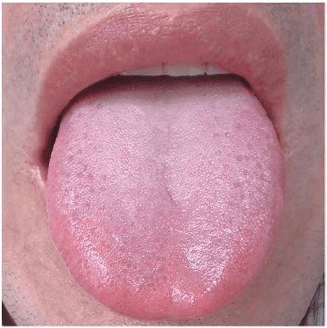 【舌诊】察舌头快速识别疾病